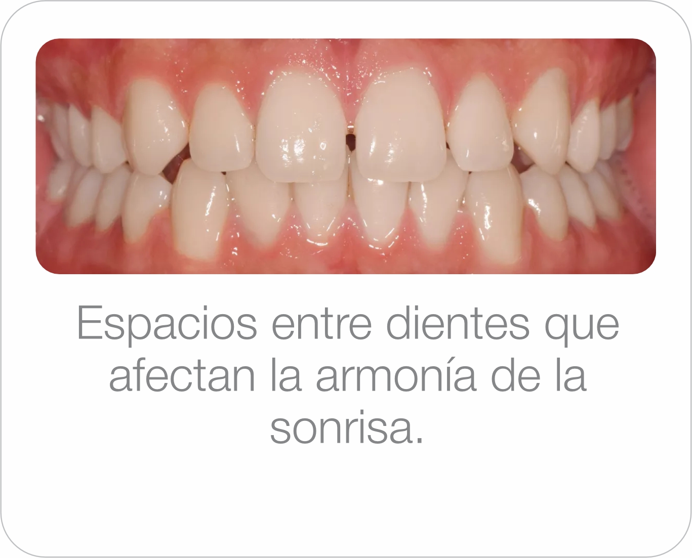 Caso real - Diastemas